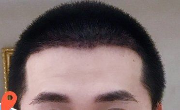 -大麦微针植发丨全国连锁