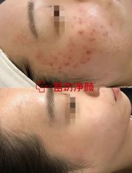 -苗坊净颜痘斑美容护肤连锁