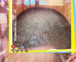 -大麦微针植发全国连锁