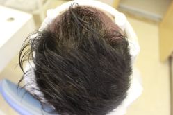 -大麦微针植发丨全国连锁