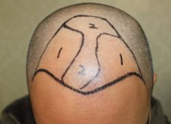 -大麦微针植发丨全国连锁