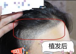 -大麦微针植发全国连锁