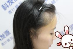 -大麦微针植发丨全国连锁