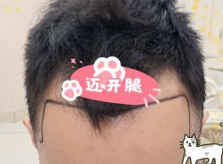 -大麦微针植发全国连锁