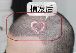 -大麦微针植发丨全国连锁