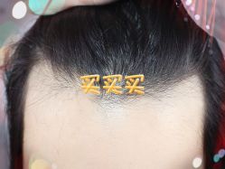 -大麦微针植发全国连锁