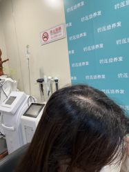 -碧莲盛·不剃发植发