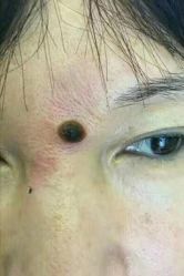 -北京美痣堂古方祛痣斑疣瘊