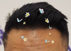 -大麦微针植发全国连锁