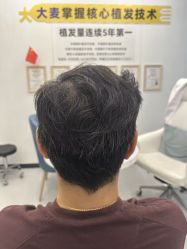-大麦微针植发全国连锁