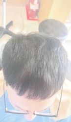 -大麦微针植发丨全国连锁