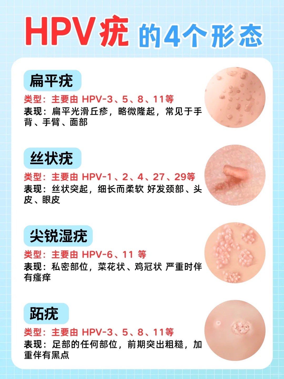 hpv疣的四个形态
