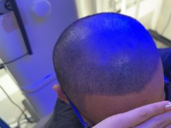 体验后-雍禾植发全国连锁