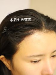 -大麦微针植发全国连锁