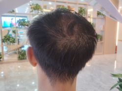 -碧莲盛·不剃发植发