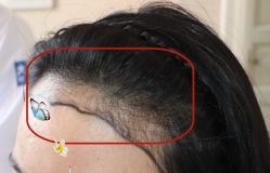 -大麦微针植发全国连锁