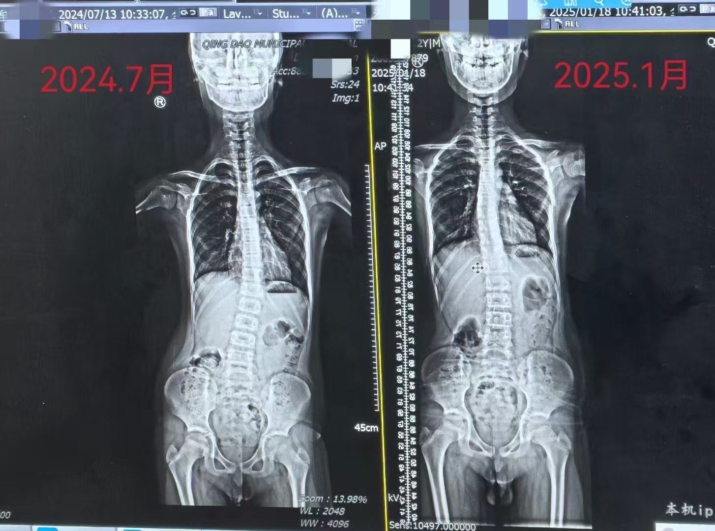 成长轨迹:骨骼x光对比
