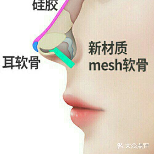 听说隆完鼻👃,不能🙅捏鼻子是真的吗?