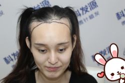 -大麦微针植发丨全国连锁