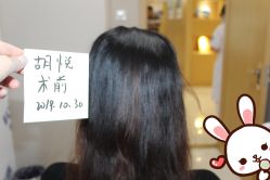 点击看大图 -大麦微针植发丨全国连锁