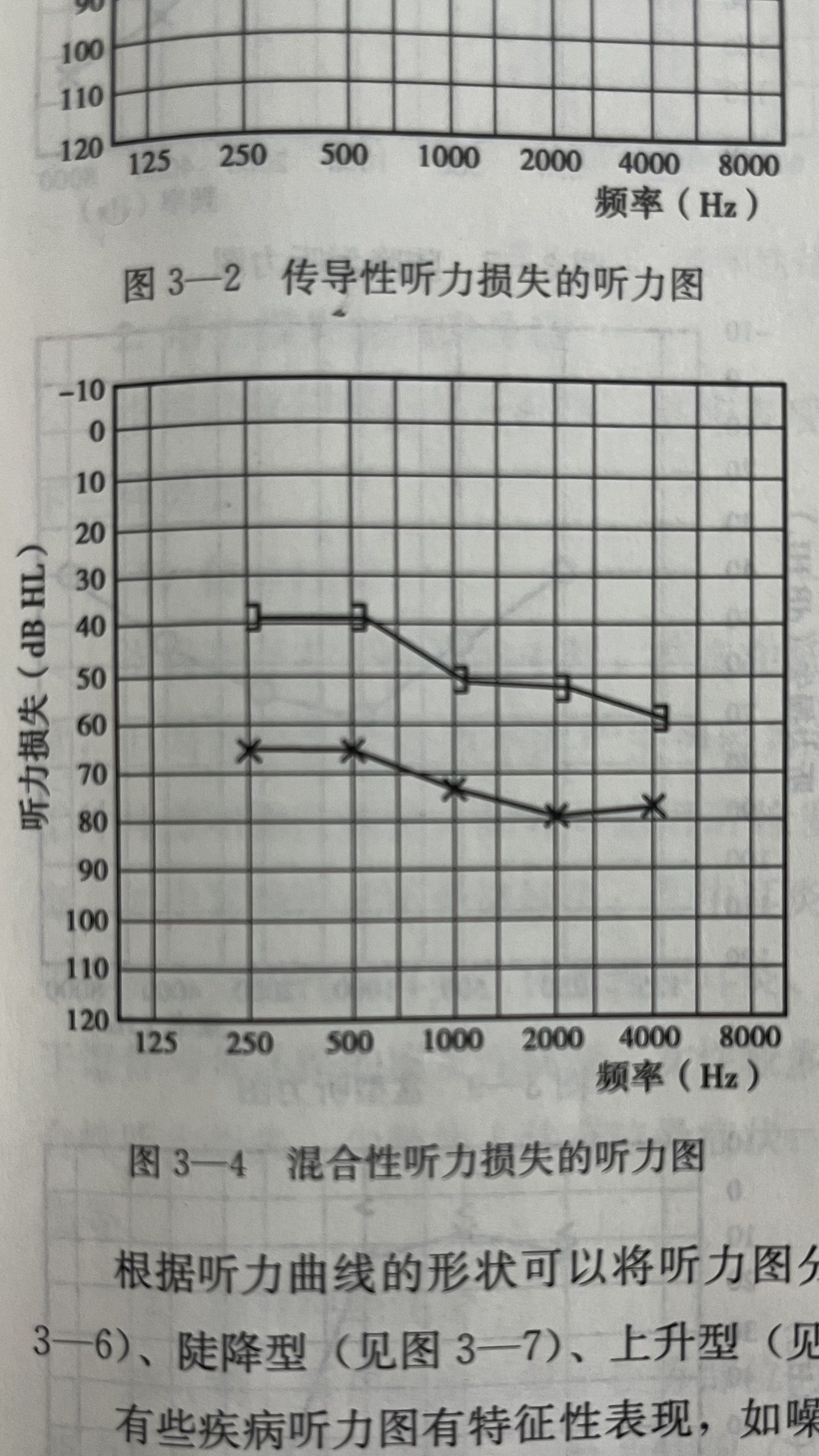 听力损失类型