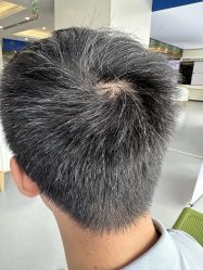 -大麦微针植发全国连锁