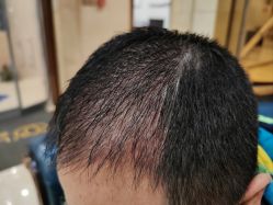 -碧莲盛·不剃发植发