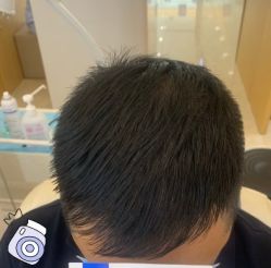 -大麦微针植发丨全国连锁