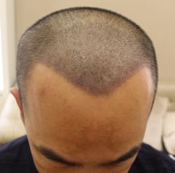-大麦微针植发丨全国连锁