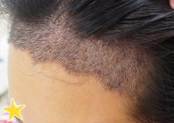 -大麦微针植发丨全国连锁