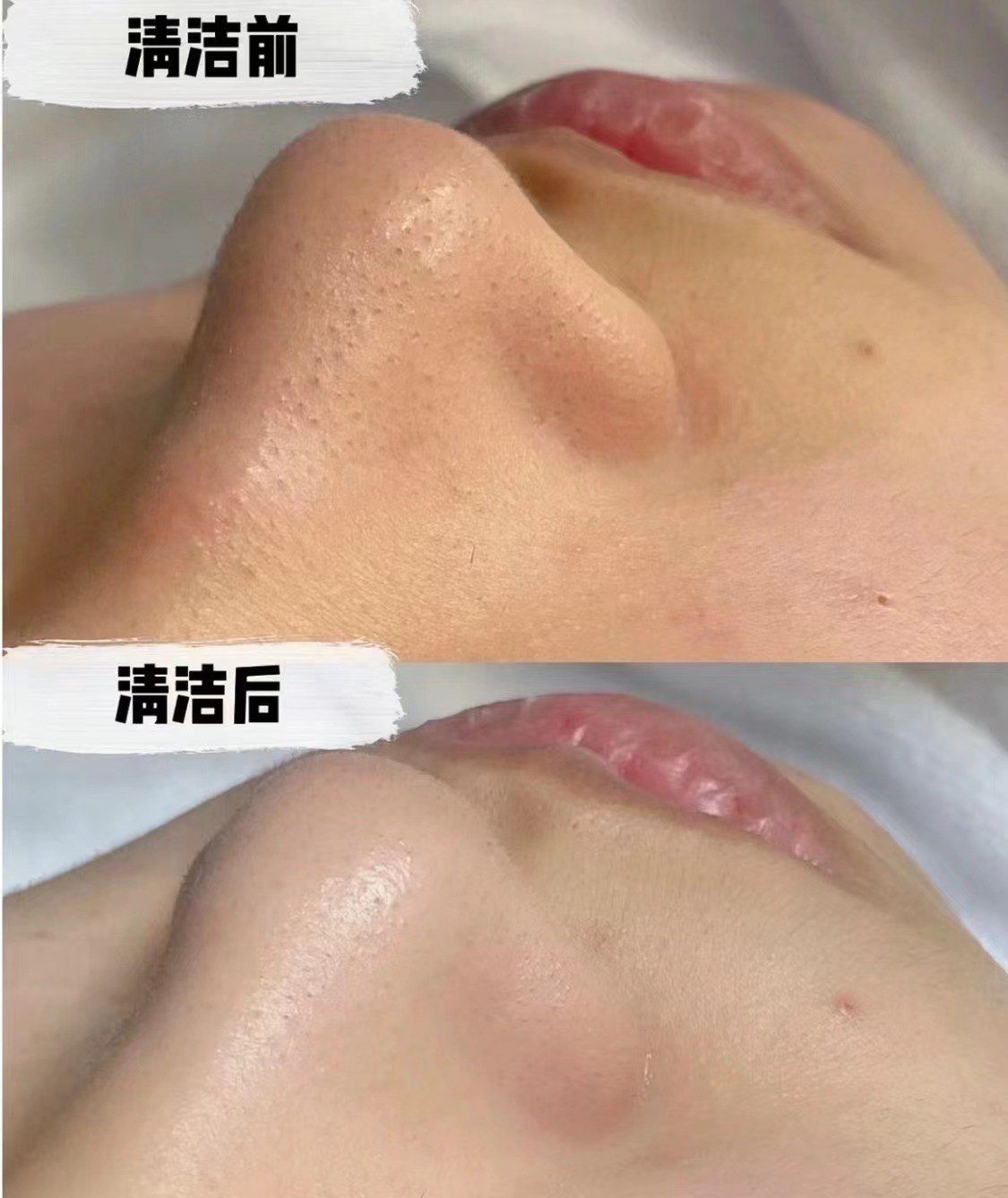 去黑头前后一次对比图