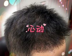 -大麦微针植发全国连锁