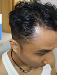 -大麦微针植发丨全国连锁