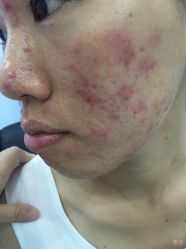 -蕾特恩专业祛痘国际连锁
