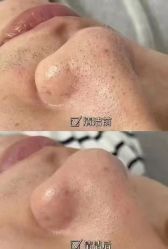 -塑青春&伊肤泉祛痘皮肤管理