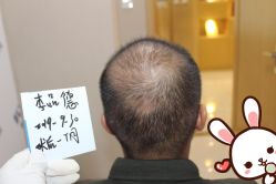 -大麦微针植发丨全国连锁