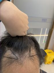 -碧莲盛不剃发植发