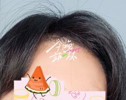 -大麦微针植发全国连锁