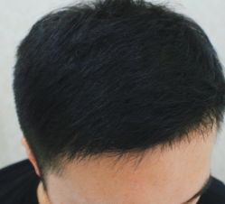 -大麦微针植发全国连锁