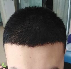 -大麦微针植发丨全国连锁
