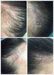 操作完 发际线 完美  ！-平萍纹绣韩式半永久定妆