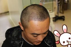 点击看大图 -大麦微针植发丨全国连锁