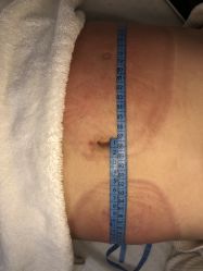 -肥三针腧穴瘦身馆