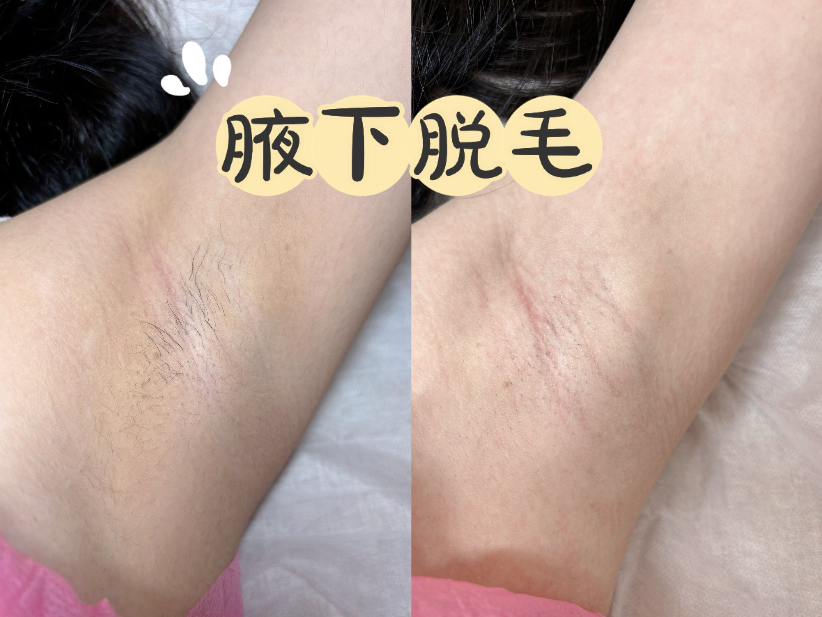 腋下脱毛