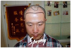 体验后-大麦微针植发全国连锁