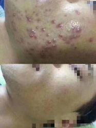 -瑶芳清颜草本祛痘