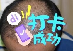-大麦微针植发全国连锁