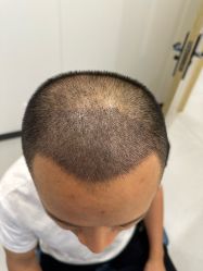 -大麦微针植发全国连锁