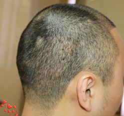 -大麦微针植发丨全国连锁