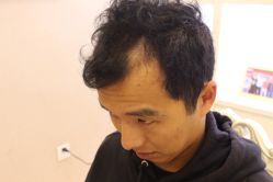 点击看大图 -大麦微针植发丨全国连锁